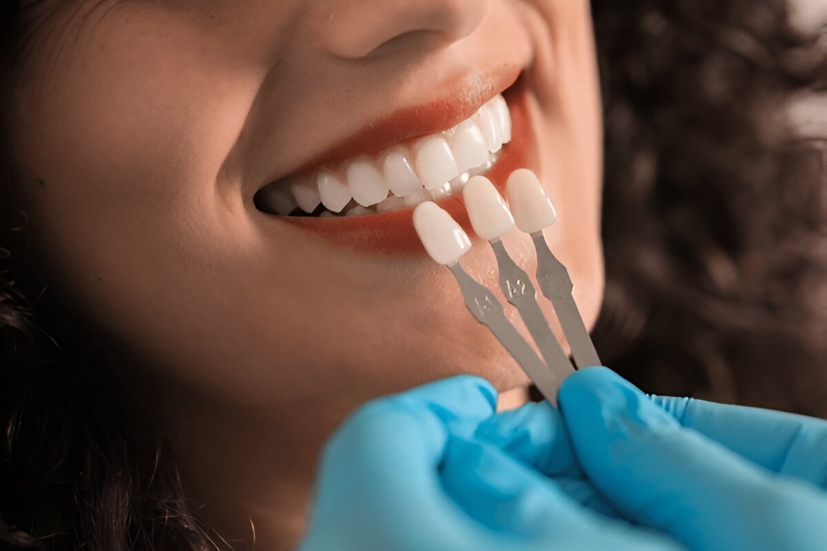 Dental veneer
