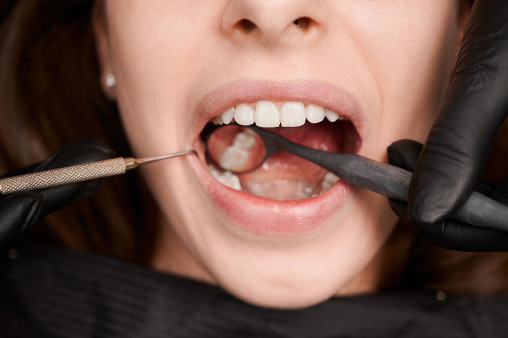Teeth Filling