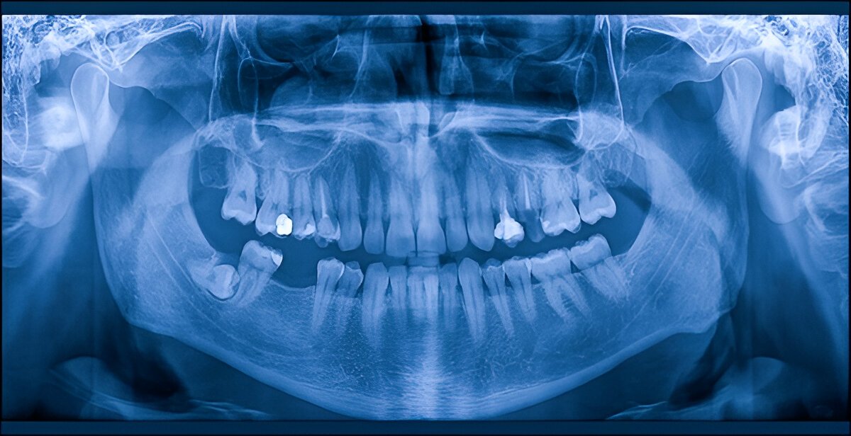 X-ray