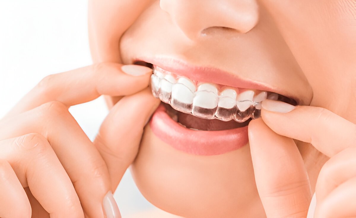 aligners