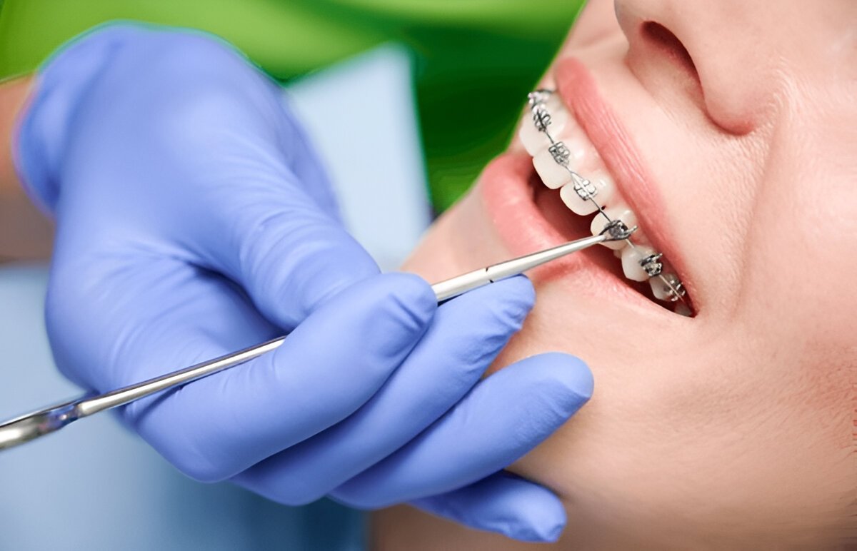 braces