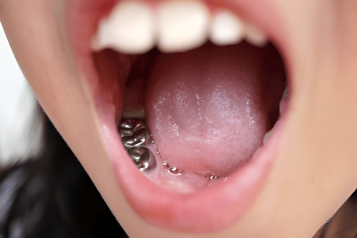 filling