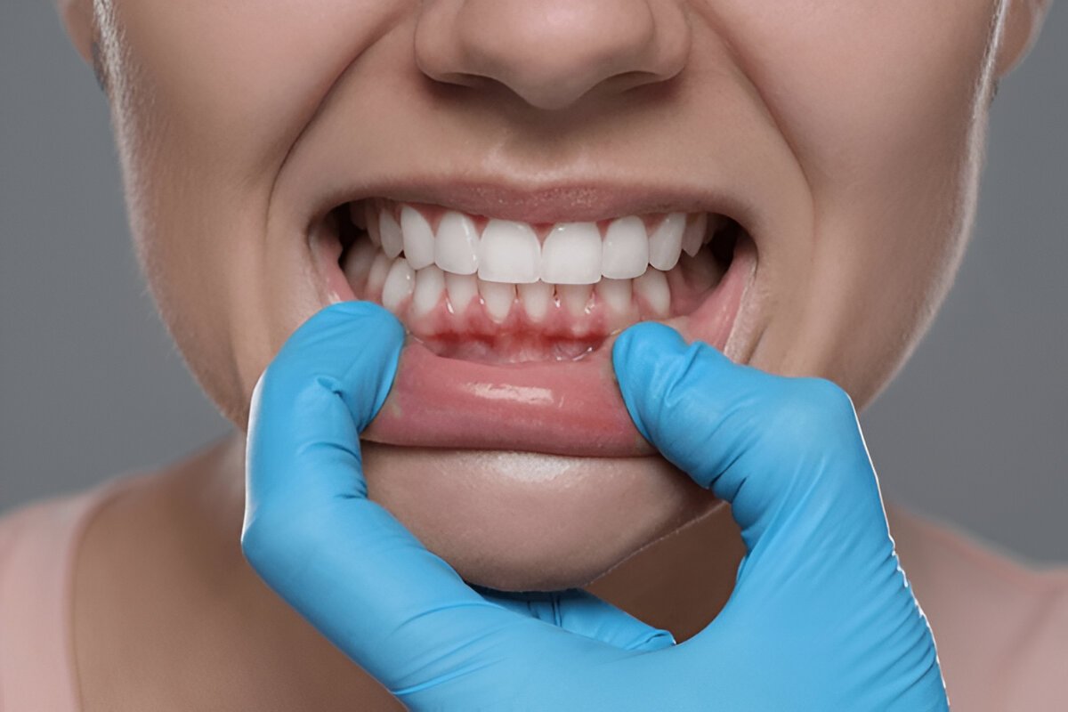 gum treatment