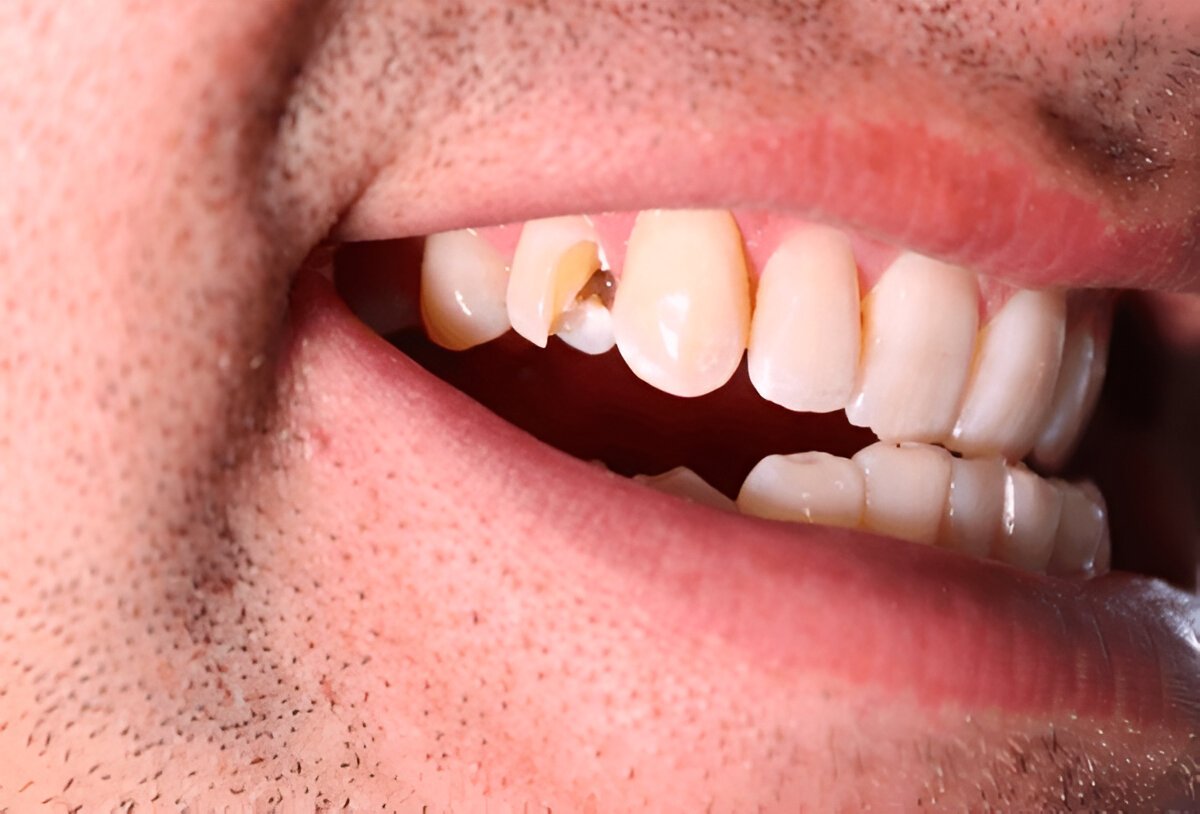 teeth filing